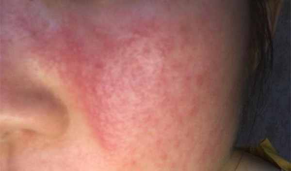 艾洛松软膏能用在脸上吗？可以用来修复面部皮炎吗？