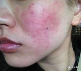 激素皮炎脸结痂难受，激素脸皮肤能用香油保湿吗？